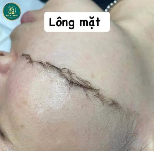 Lông mặt trước khi triệt tại Hoa Anh